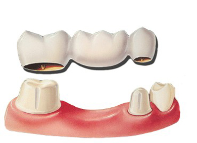 Diagram of a dental bridge