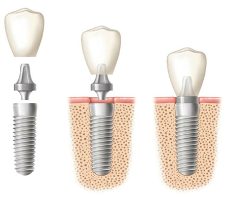 Diagram of dental imlant components, including the root form, connector, and crown