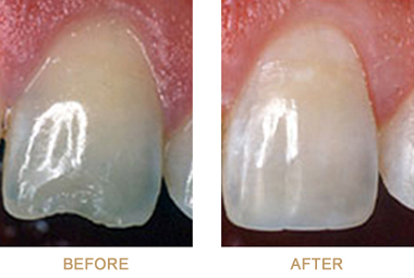 Chipped tooth before-and-after photos