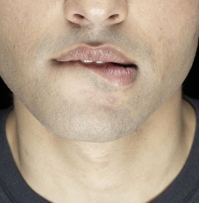 Man biting his lips portraying bleeding gums and dental anxiety