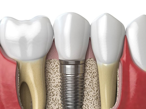 Digital model of a dental implant in the bone - for info on affordable dentistry in Plano, TX