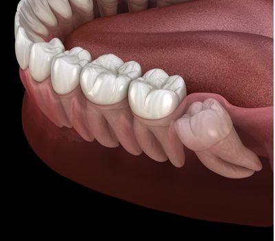 Diagram of an impacted wisdom tooth