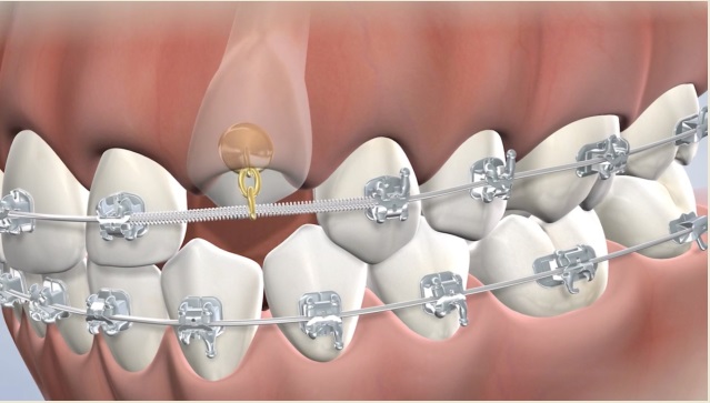 Diagram of an impacted canine tooth with a bracket on it, which is attached to an orthodontic wire by a rubber band.